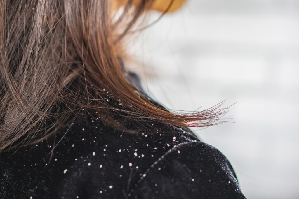 Dandruff Causes and Prevention